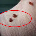 The Miracle Recipe That Can Make Skin Tags Disappear In No Time